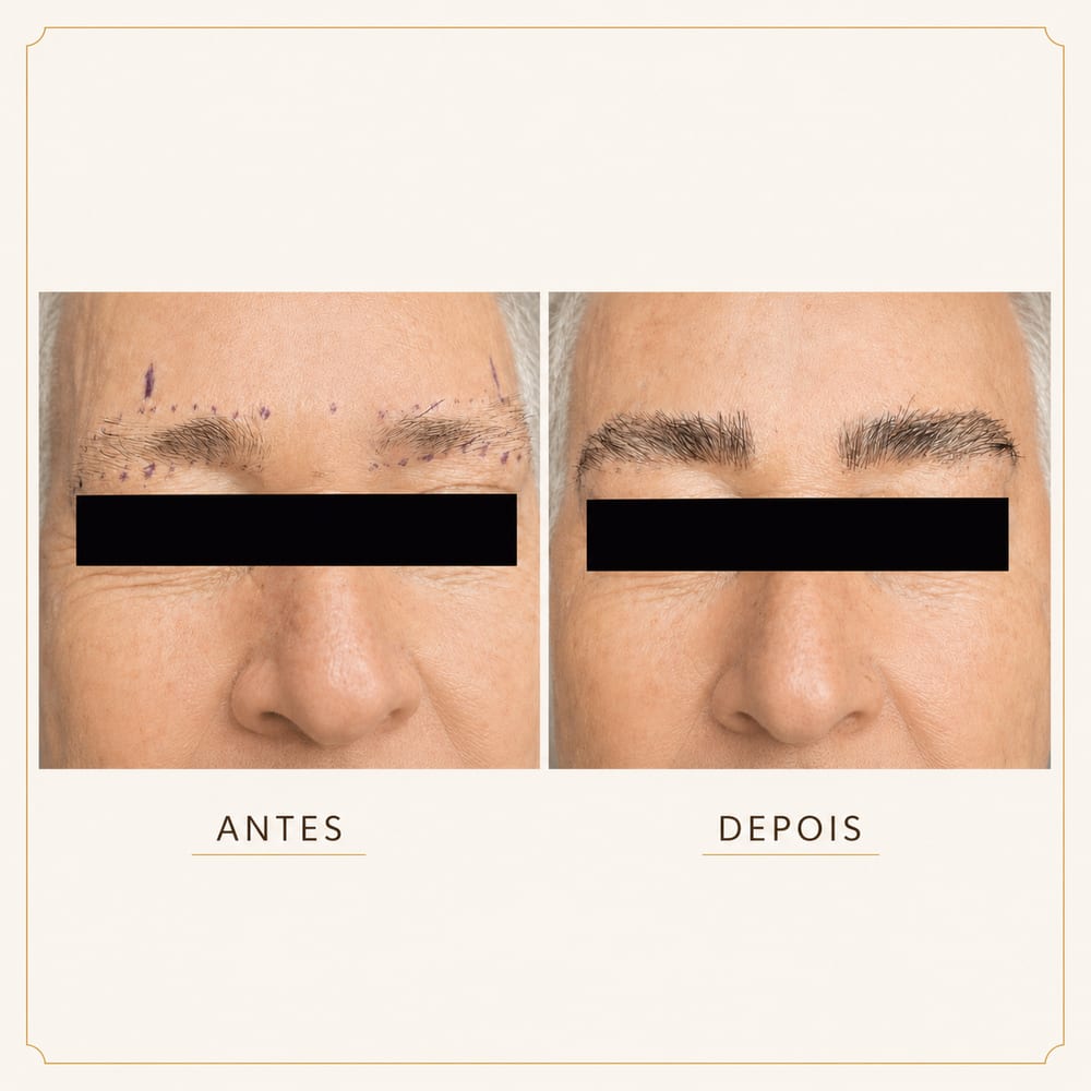 Antes e depois de transplante de sobrancelhas — simetria — na LiCap em Florianópolis/SC